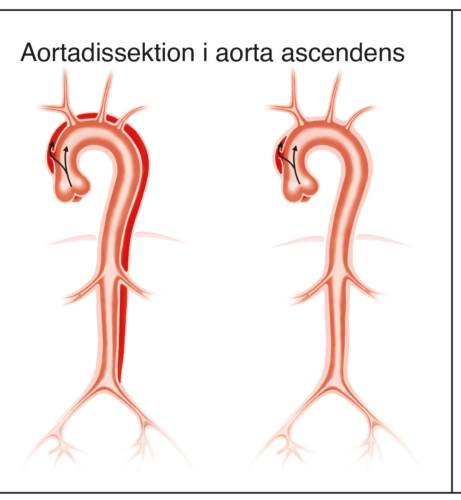 Aortadissektion typ-A