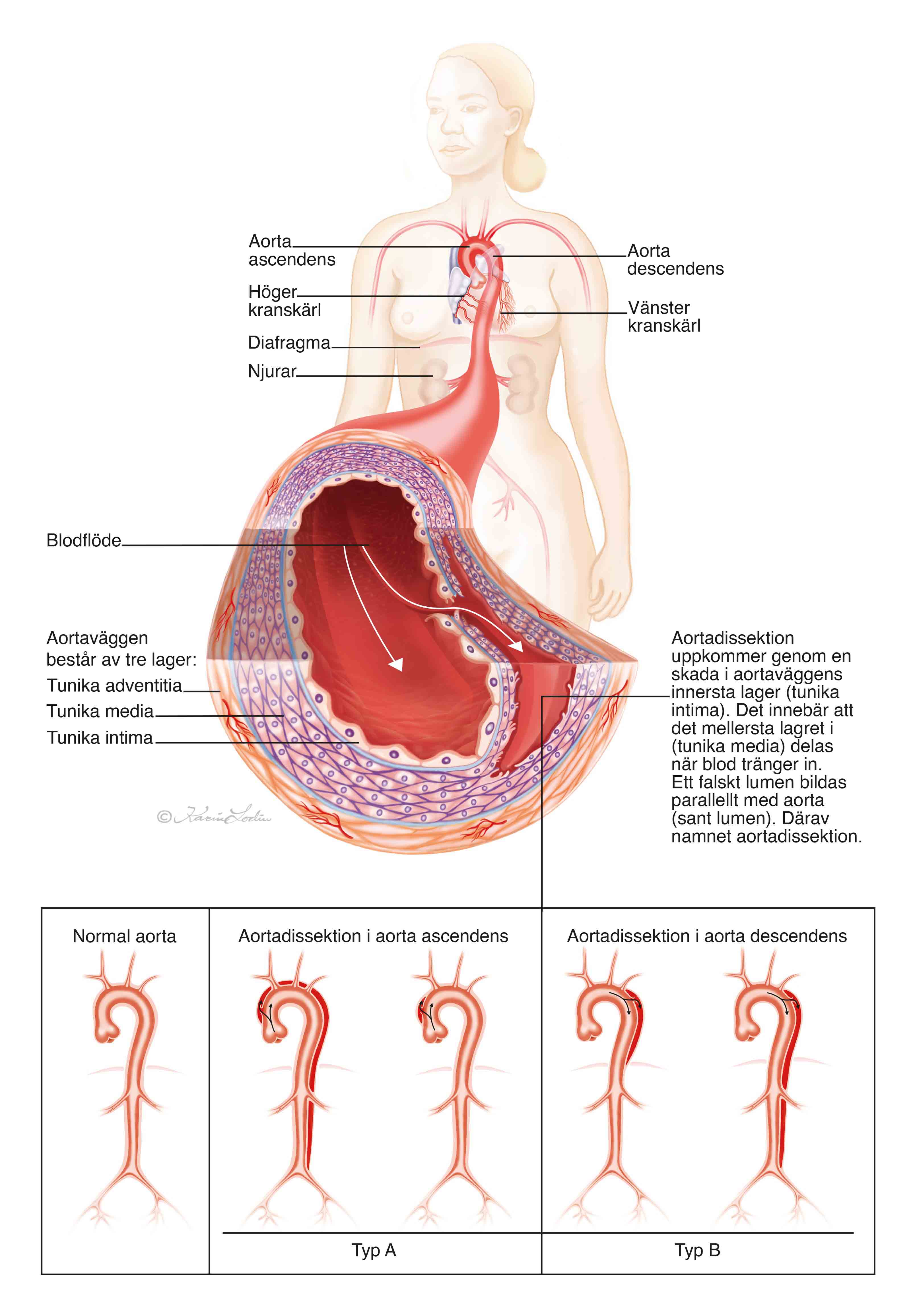 Illustration över vad som händer vid en aortadissektion