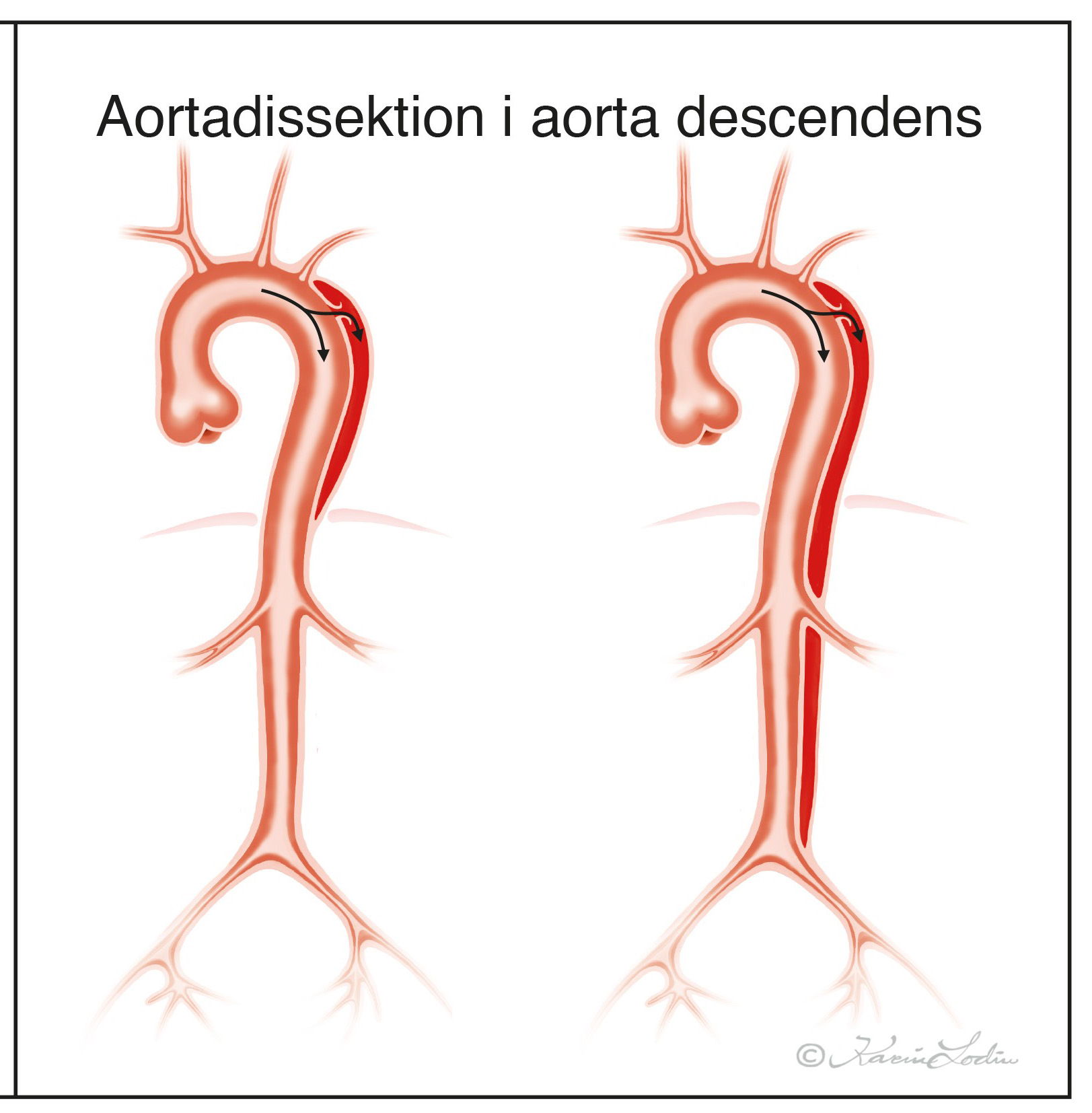 Aortadissektion typ-B