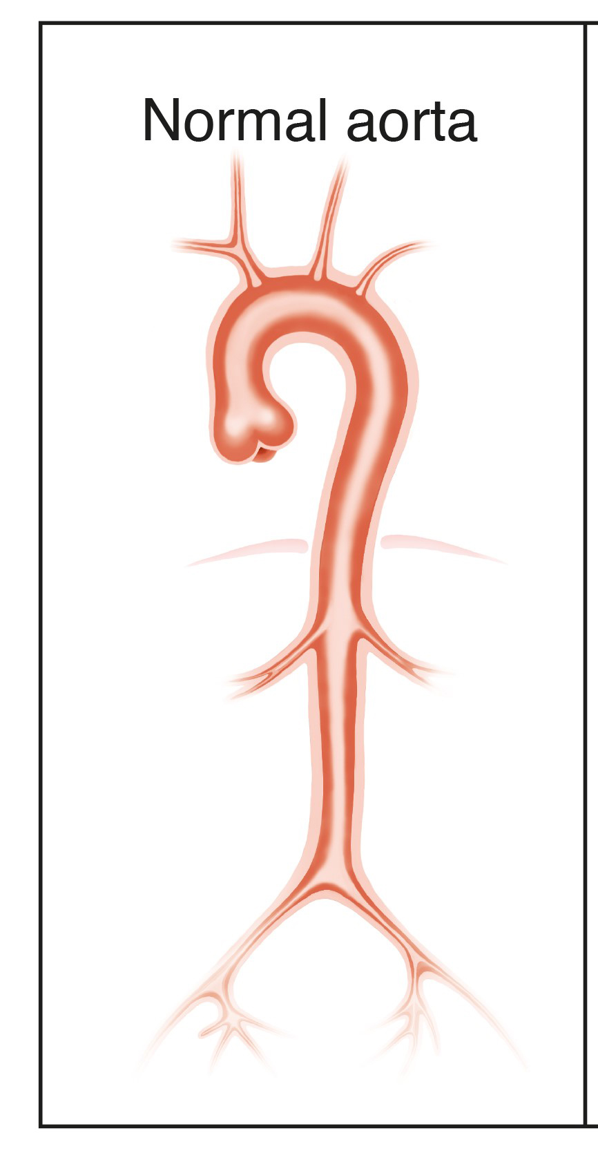 Normal aorta