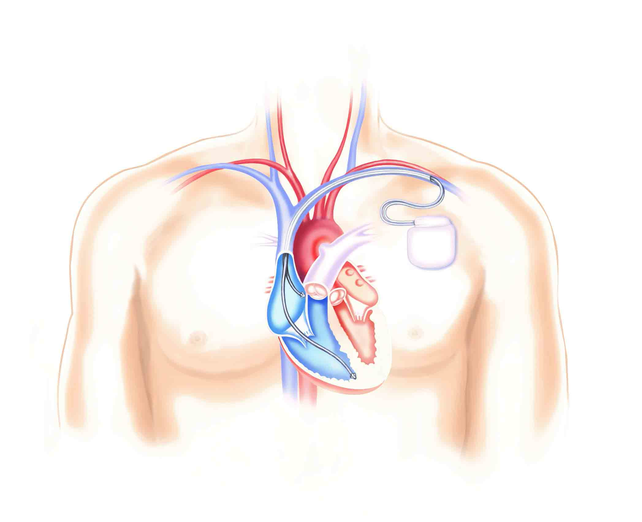 En inopererad defibrillator kallas också ICD efter den engelska förkortningen Implantable Cardioverter Defibrillator.