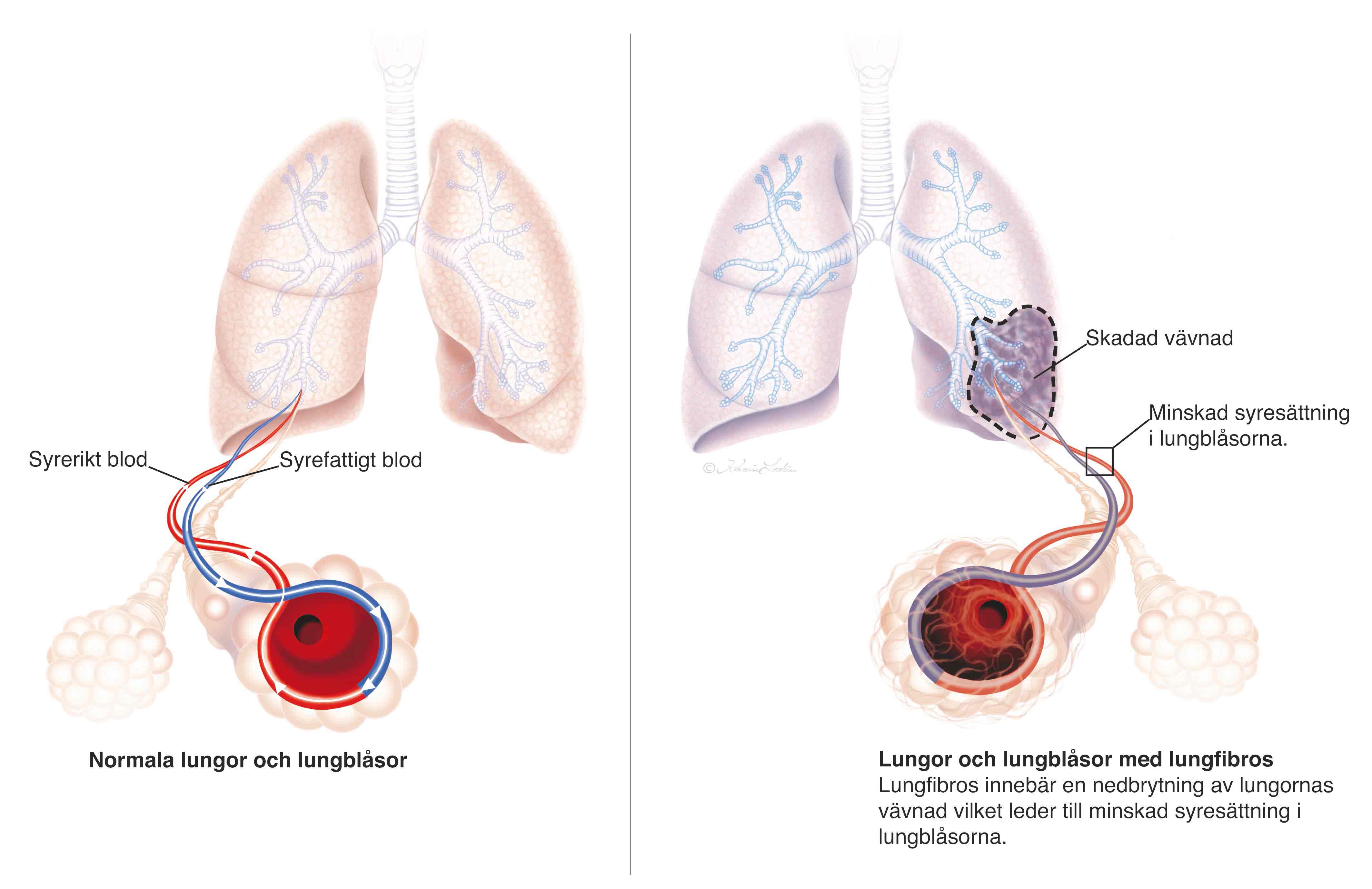 Lungfibros.