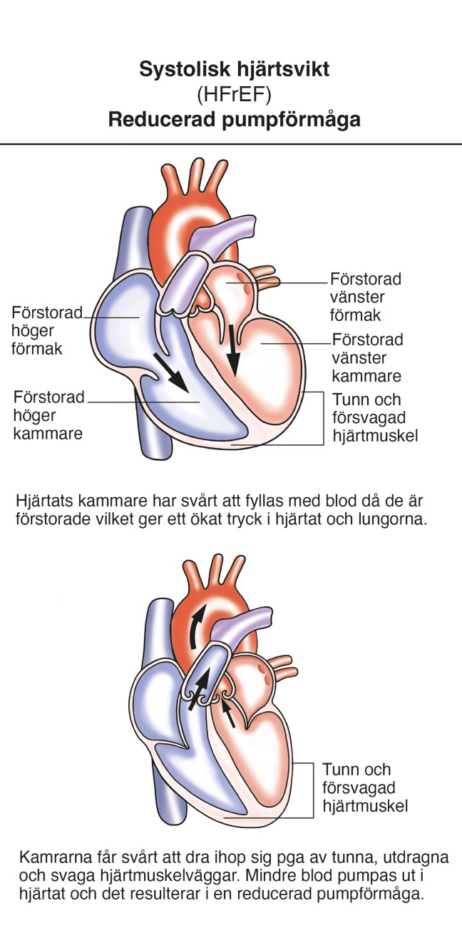 hjärtsvikt med reducerad.jpg