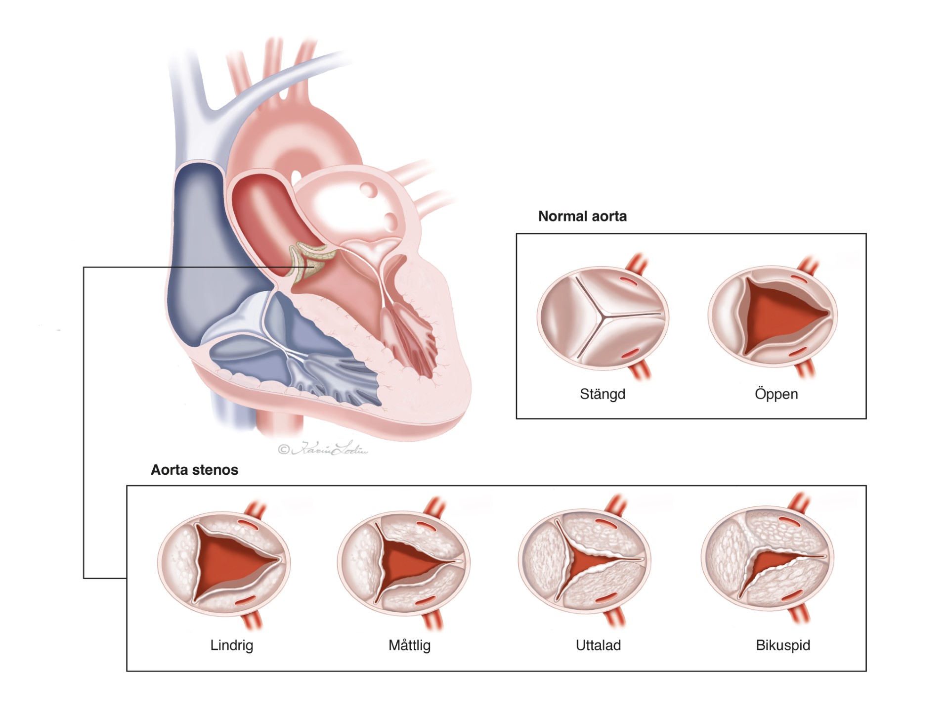 aortaklaffen i genomskärning. 