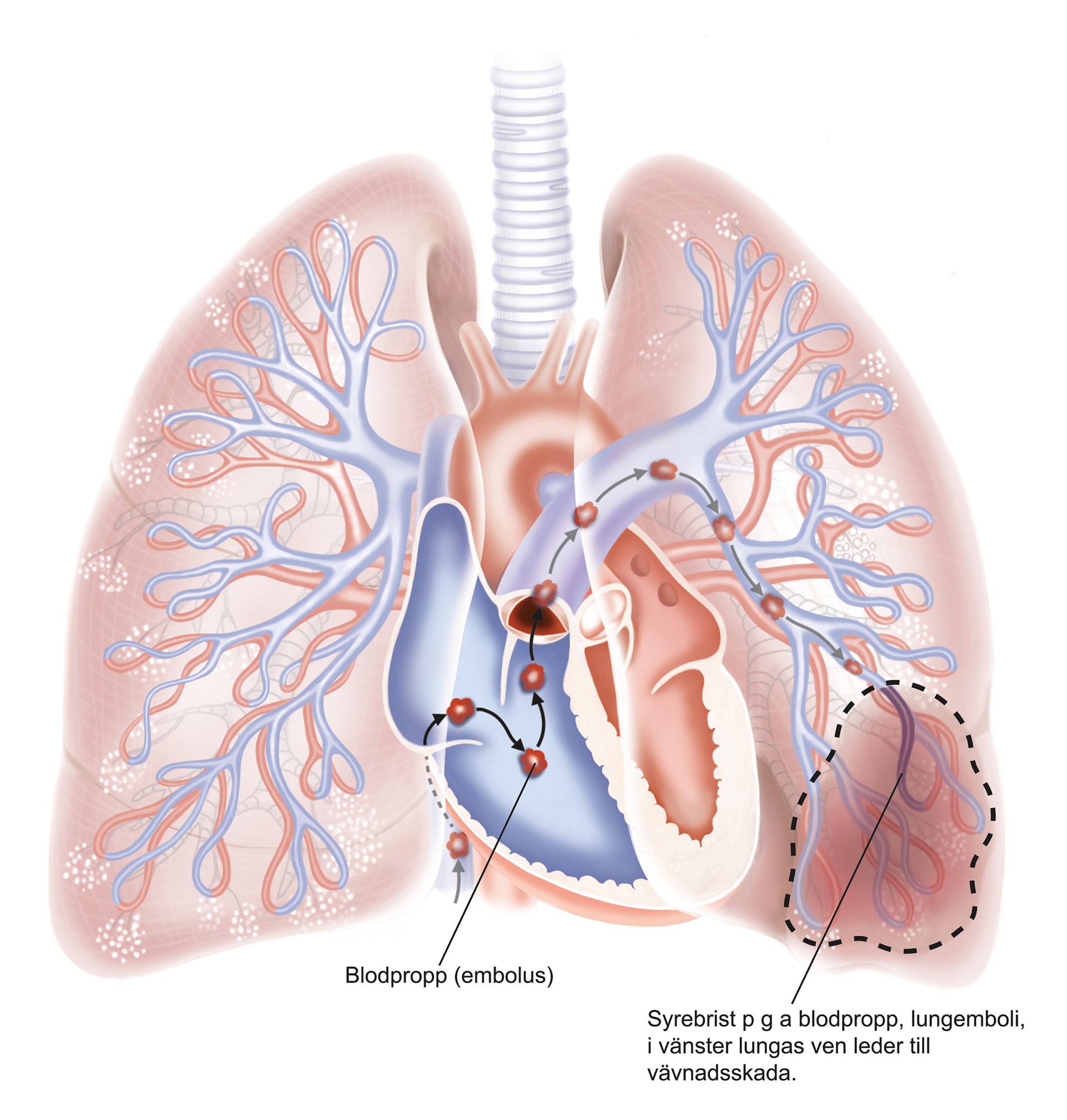 Blodpropp i lungan.