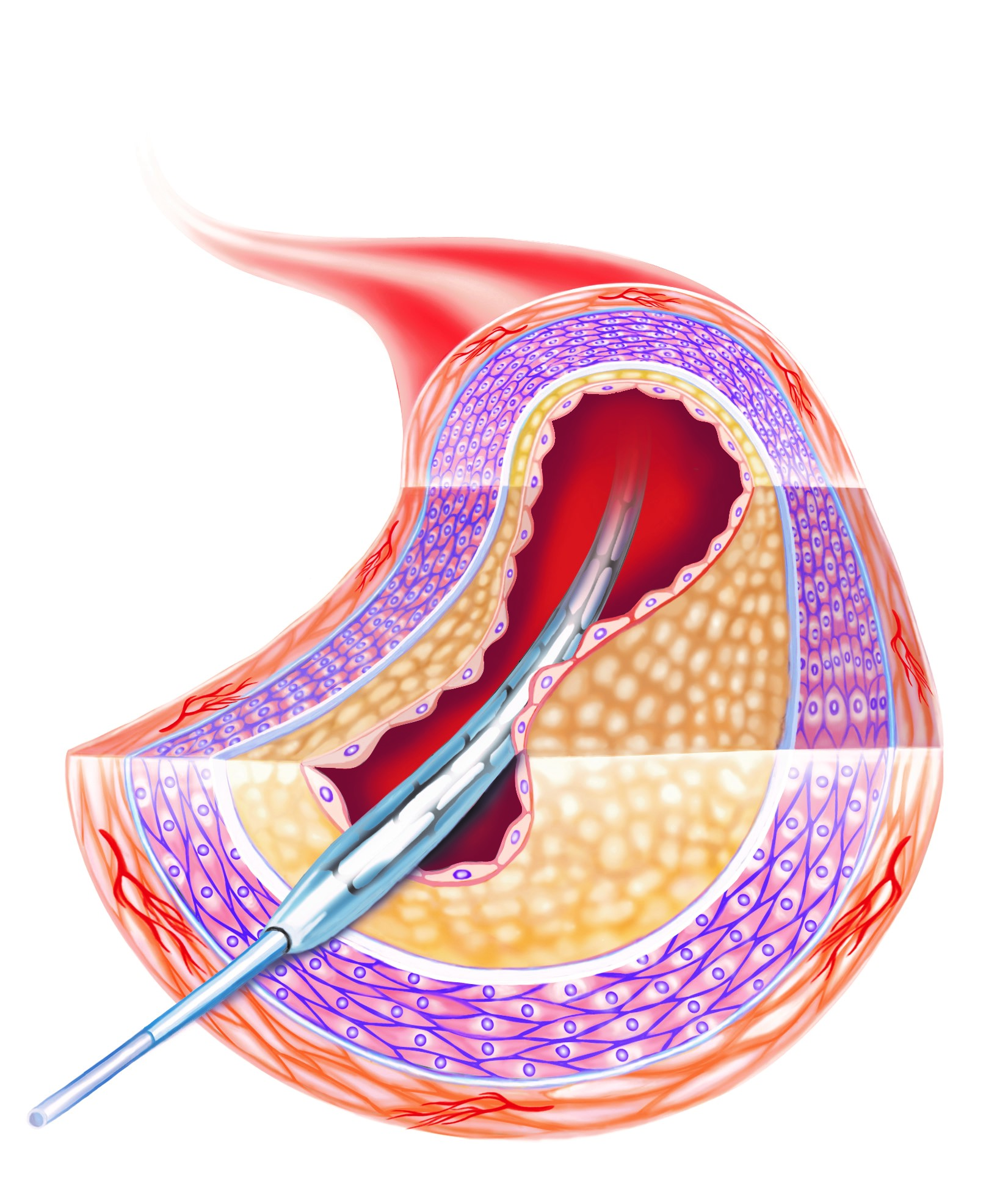 Ballongvidgning PCI.