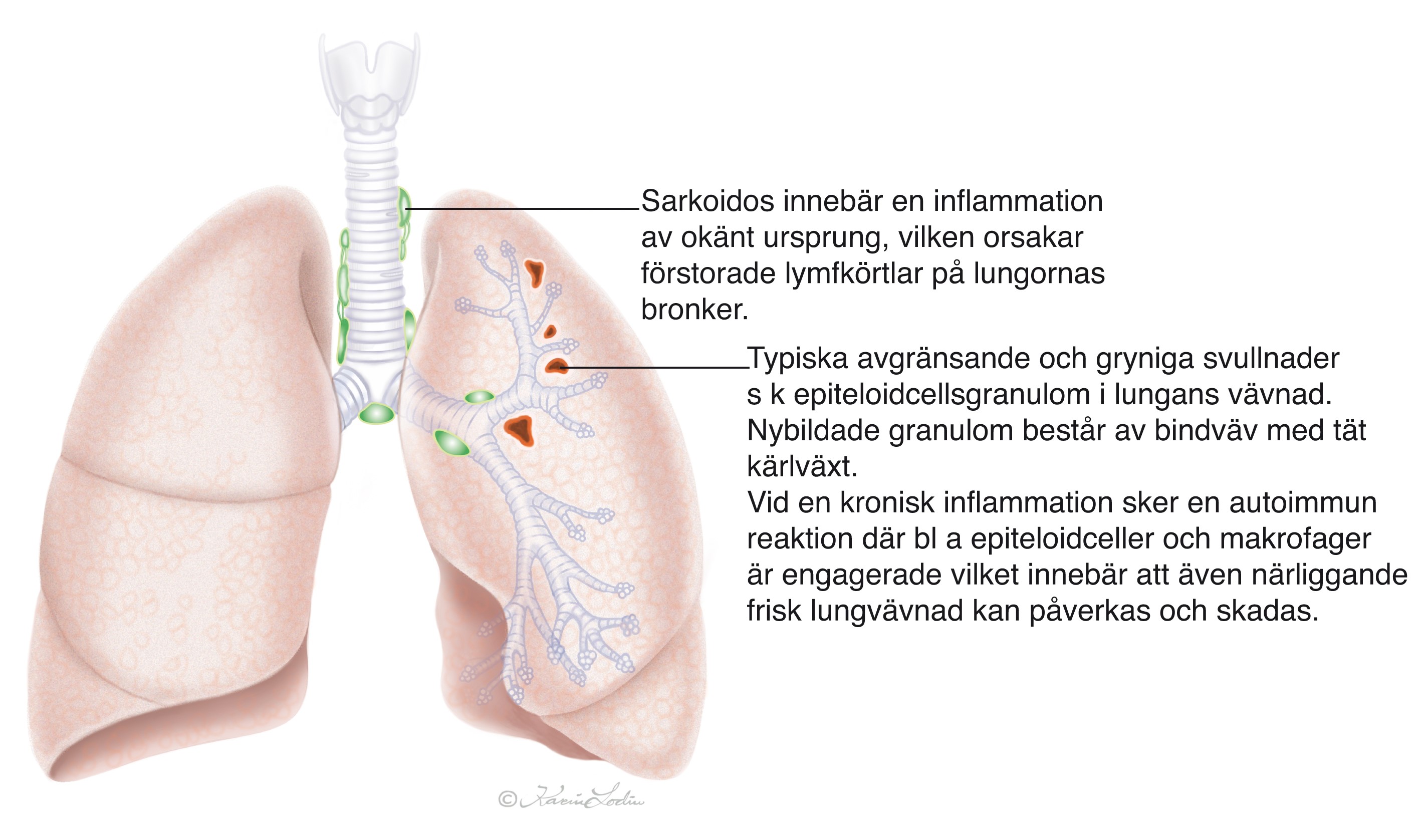 Bilden visar ett par lungor som är drabbade av sarkoidos.