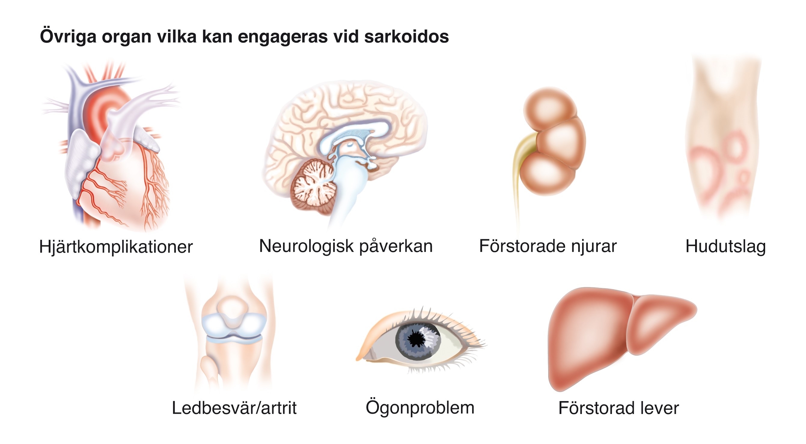 organ som kan drabbas av sarkoidos.