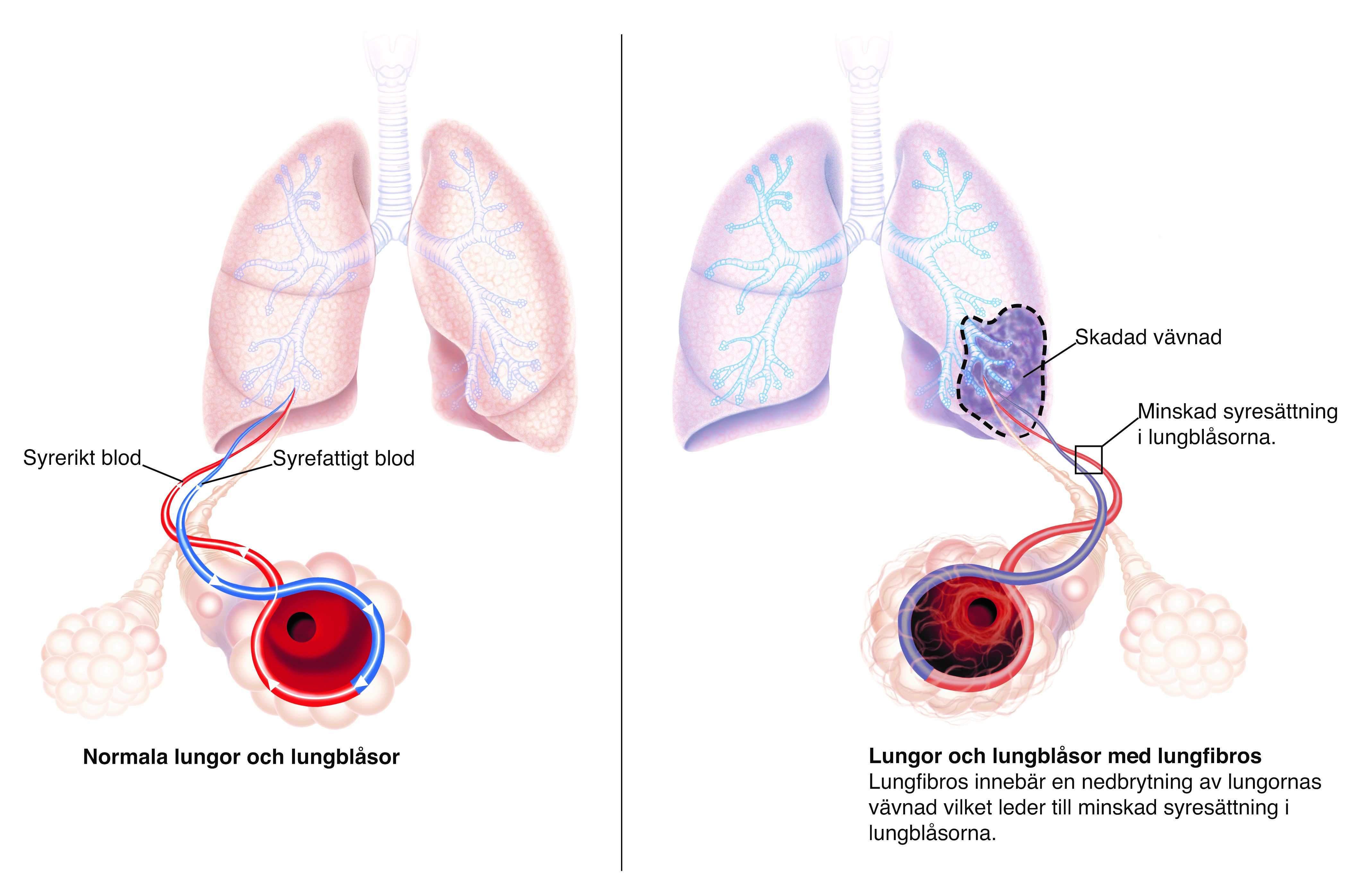 Lungor och lungblåsor drabbade av lungfibros.