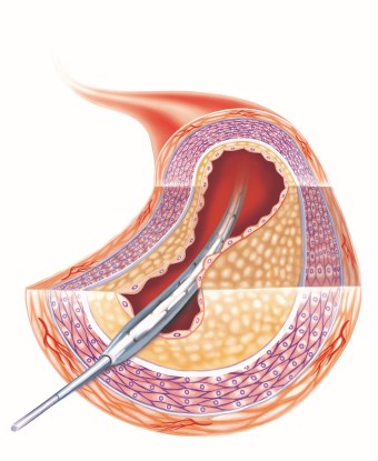 Ballongvidgning PCI.