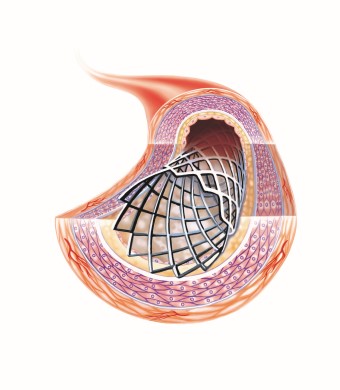 Ett metallnät, stent, håller kranskärlet utvidgat.